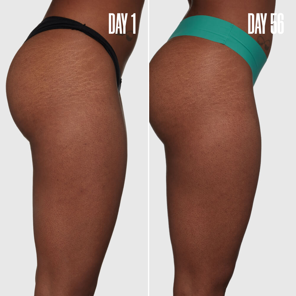 Outer Thigh Stretch Mark Cream product